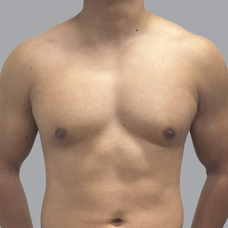 Gynecomastia Before & After Gallery - Patient 380227 - Image 2