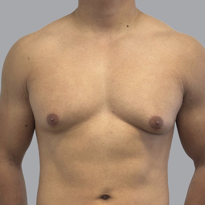 Gynecomastia Before & After Gallery - Patient 380227 - Image 1