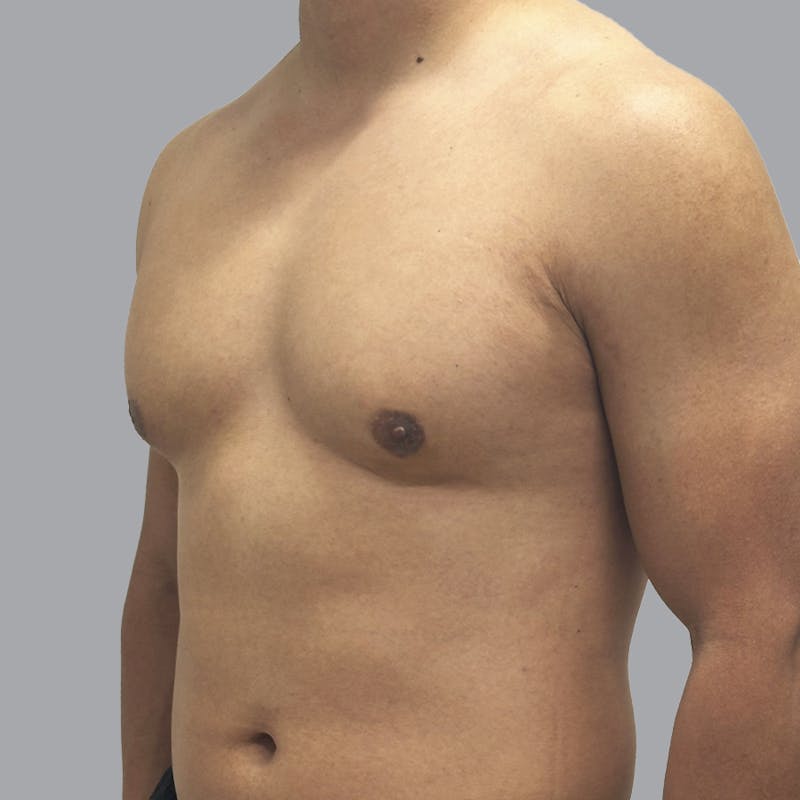 Gynecomastia Before & After Gallery - Patient 380227 - Image 6