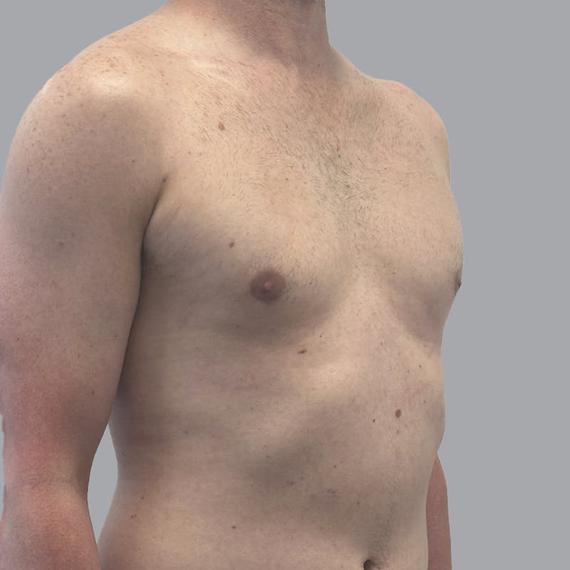 Gynecomastia Before & After Gallery - Patient 248582 - Image 4