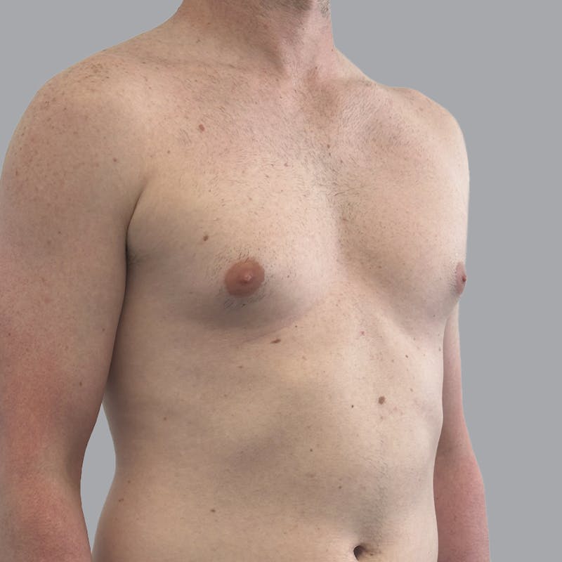 Gynecomastia Before & After Gallery - Patient 248582 - Image 3