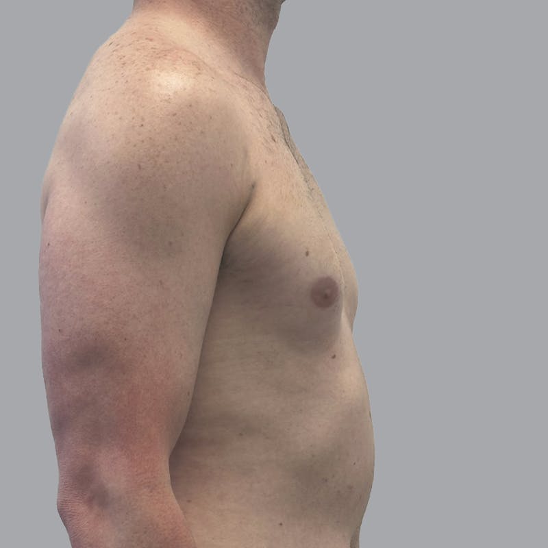 Gynecomastia Before & After Gallery - Patient 248582 - Image 6
