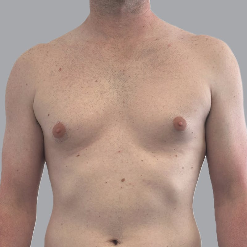 Gynecomastia Before & After Gallery - Patient 248582 - Image 1