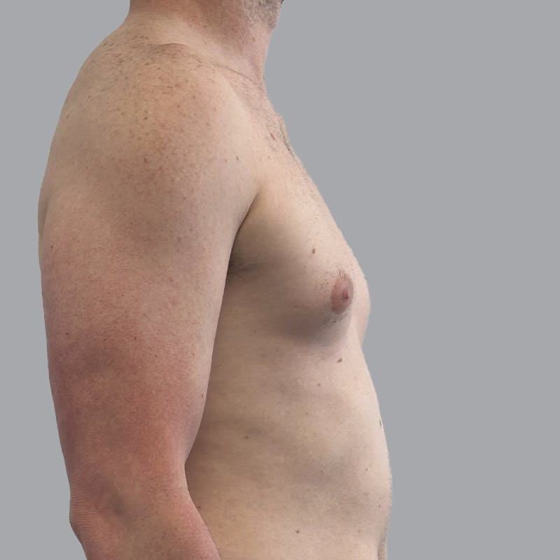Gynecomastia Before & After Gallery - Patient 248582 - Image 5