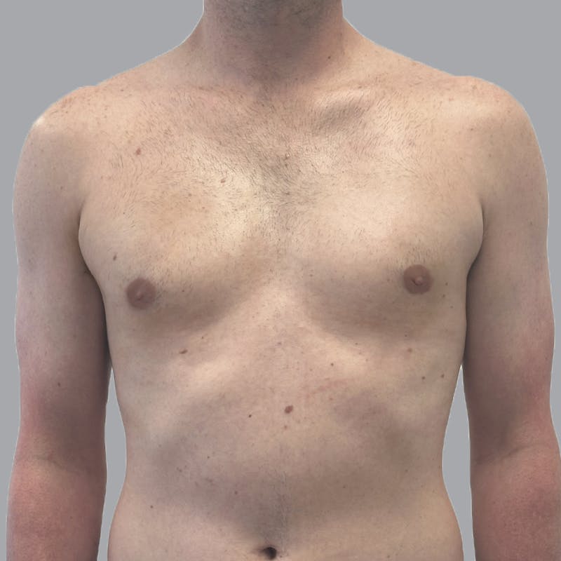 Gynecomastia Before & After Gallery - Patient 248582 - Image 2