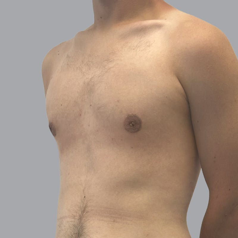 Gynecomastia Before & After Gallery - Patient 180189 - Image 6
