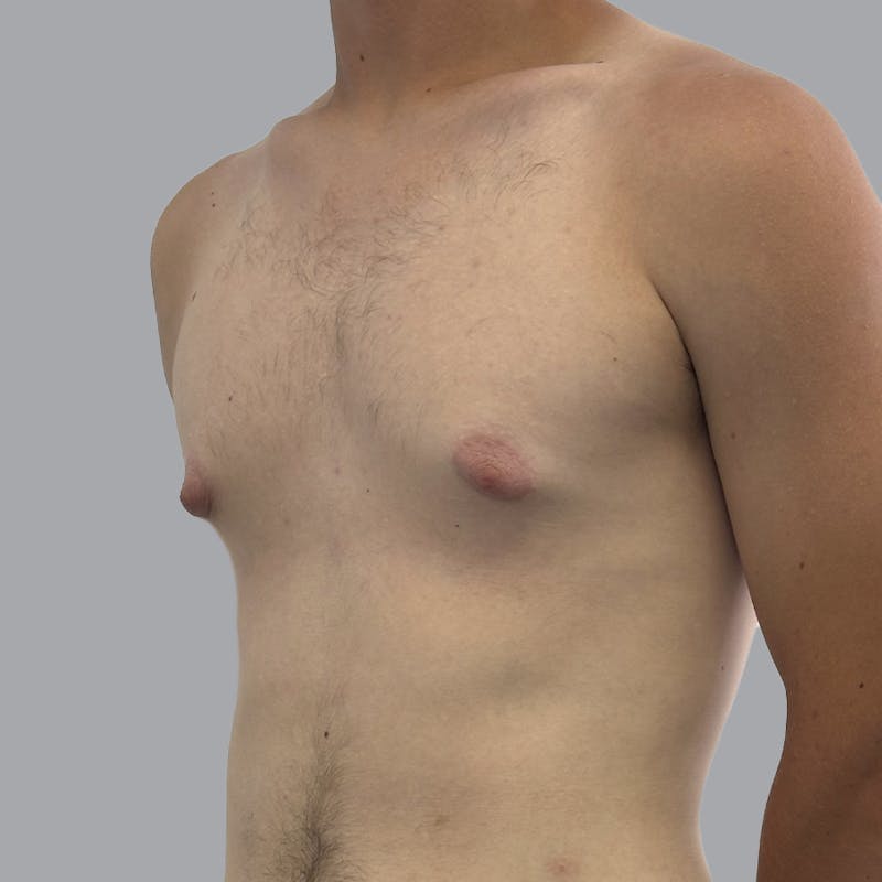 Gynecomastia Before & After Gallery - Patient 180189 - Image 5