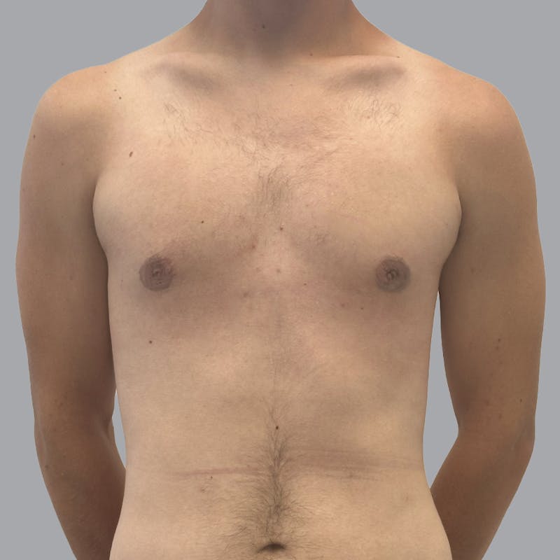 Gynecomastia Before & After Gallery - Patient 180189 - Image 2