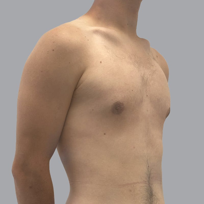 Gynecomastia Before & After Gallery - Patient 180189 - Image 4