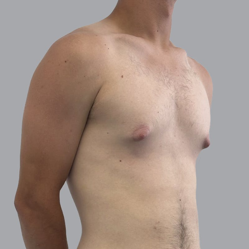 Gynecomastia Before & After Gallery - Patient 180189 - Image 3