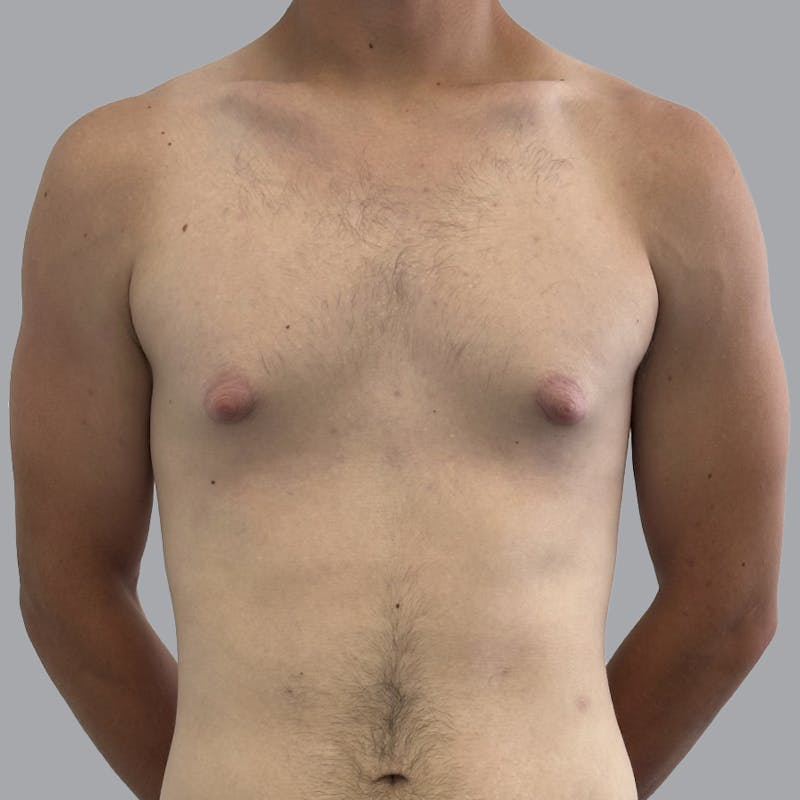 Gynecomastia Before & After Gallery - Patient 180189 - Image 1