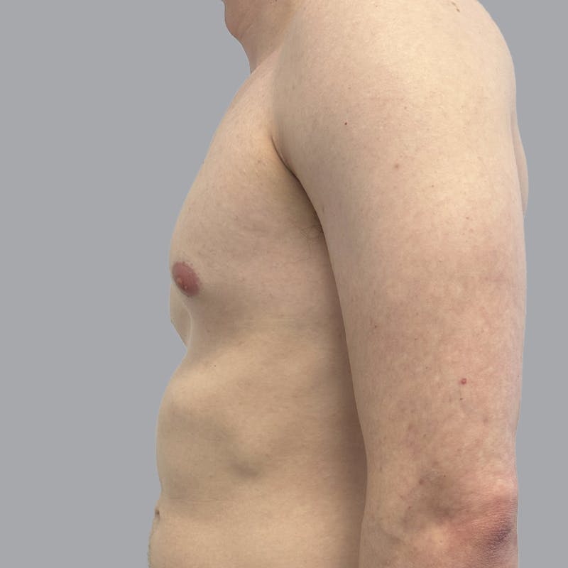 Gynecomastia Before & After Gallery - Patient 436368 - Image 5