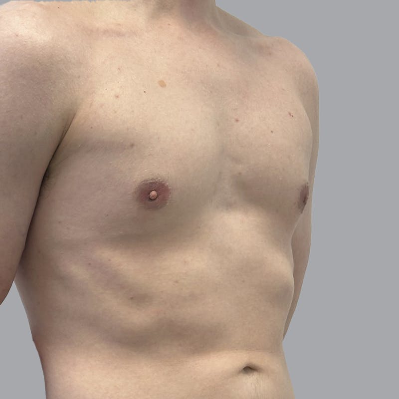 Gynecomastia Before & After Gallery - Patient 436368 - Image 2