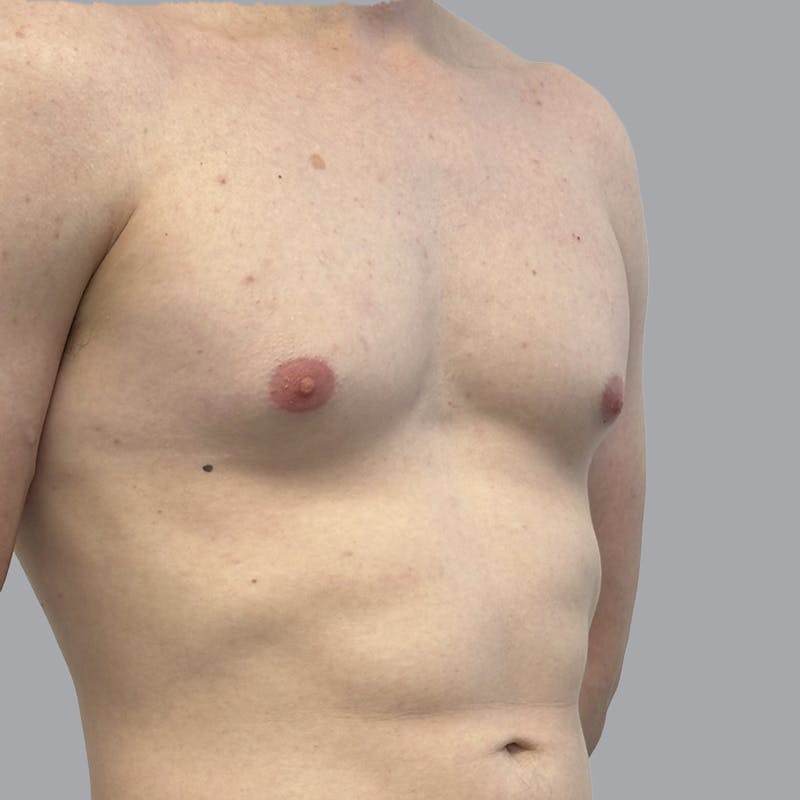Gynecomastia Before & After Gallery - Patient 436368 - Image 1