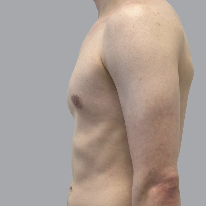 Gynecomastia Before & After Gallery - Patient 436368 - Image 6