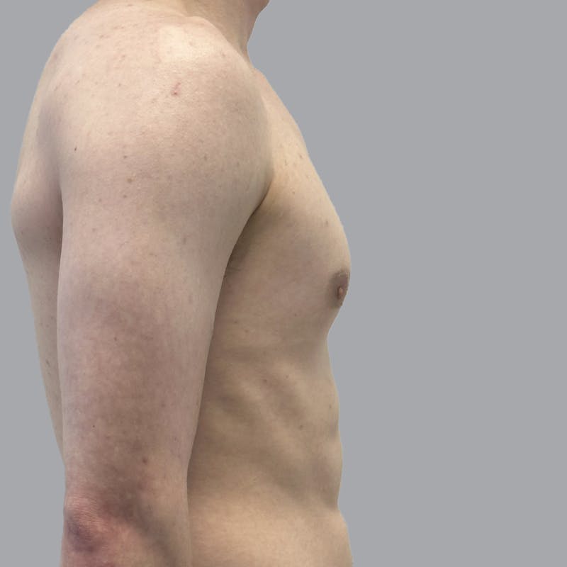 Gynecomastia Before & After Gallery - Patient 436368 - Image 4