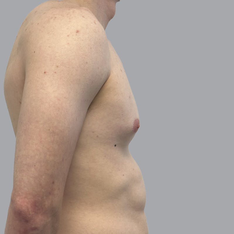 Gynecomastia Before & After Gallery - Patient 436368 - Image 3