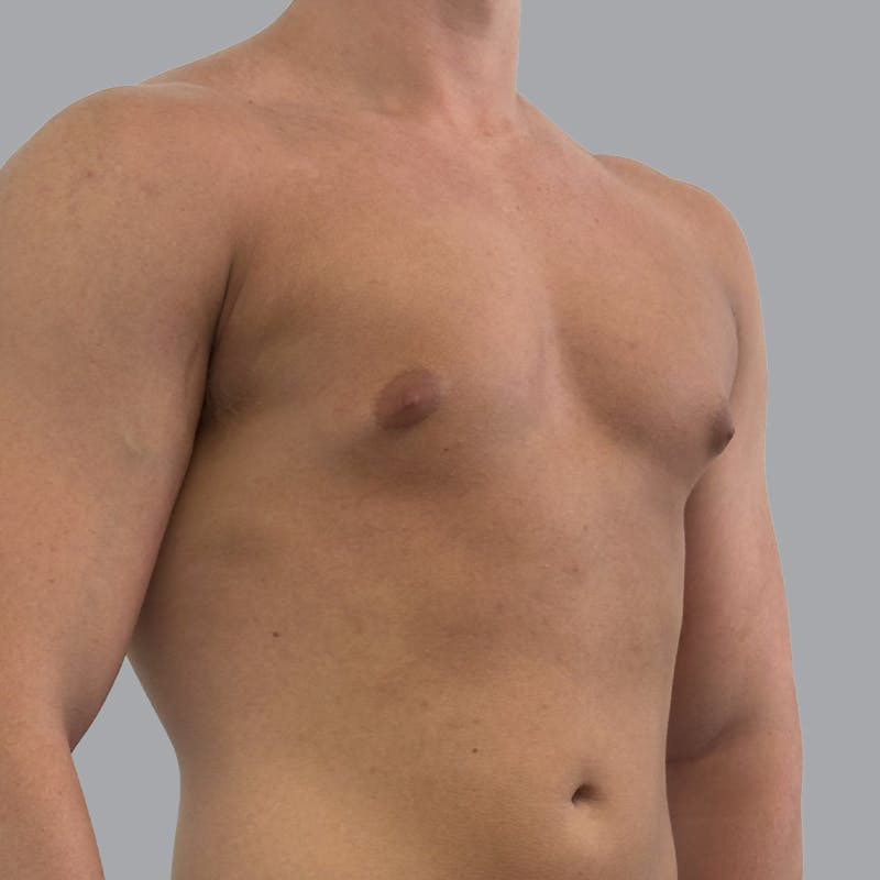Gynecomastia Before & After Gallery - Patient 290144 - Image 3