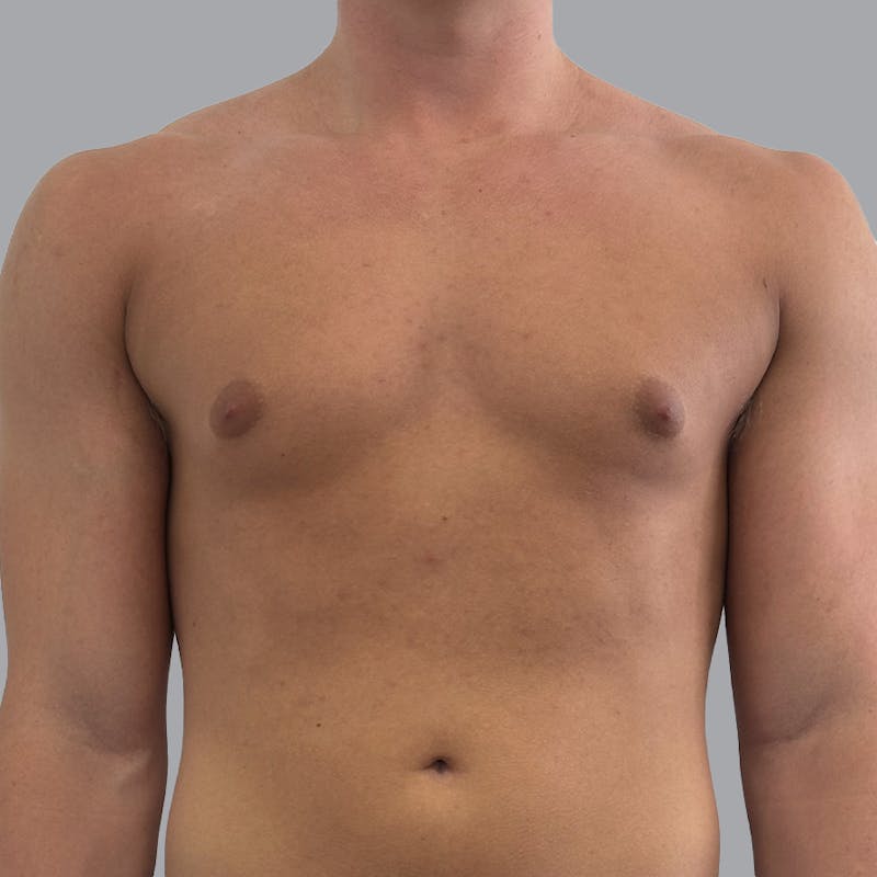 Gynecomastia Before & After Gallery - Patient 290144 - Image 1