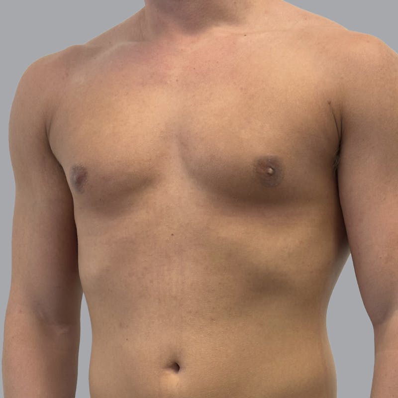 Gynecomastia Before & After Gallery - Patient 290144 - Image 6