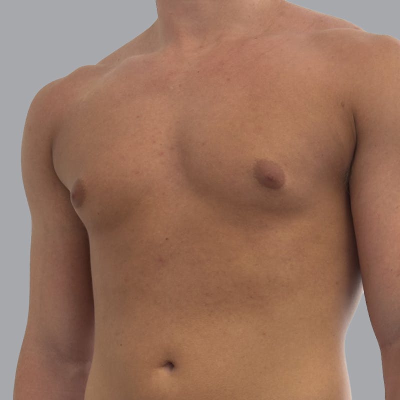Gynecomastia Before & After Gallery - Patient 290144 - Image 5