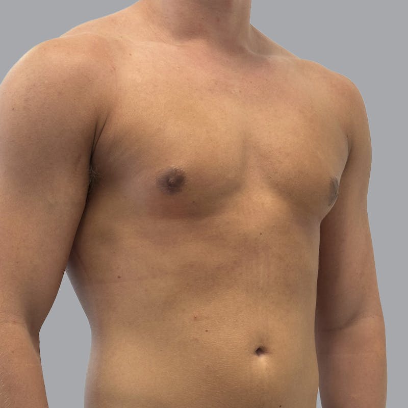 Gynecomastia Before & After Gallery - Patient 290144 - Image 4