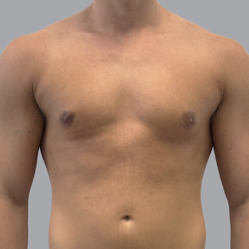 Gynecomastia Before & After Gallery - Patient 290144 - Image 2