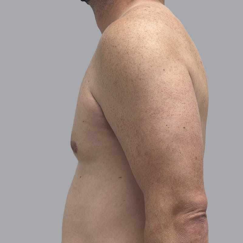 Gynecomastia Before & After Gallery - Patient 414162 - Image 6