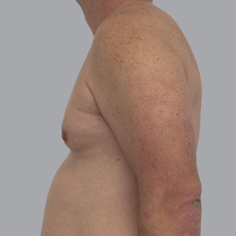 Gynecomastia Before & After Gallery - Patient 414162 - Image 5