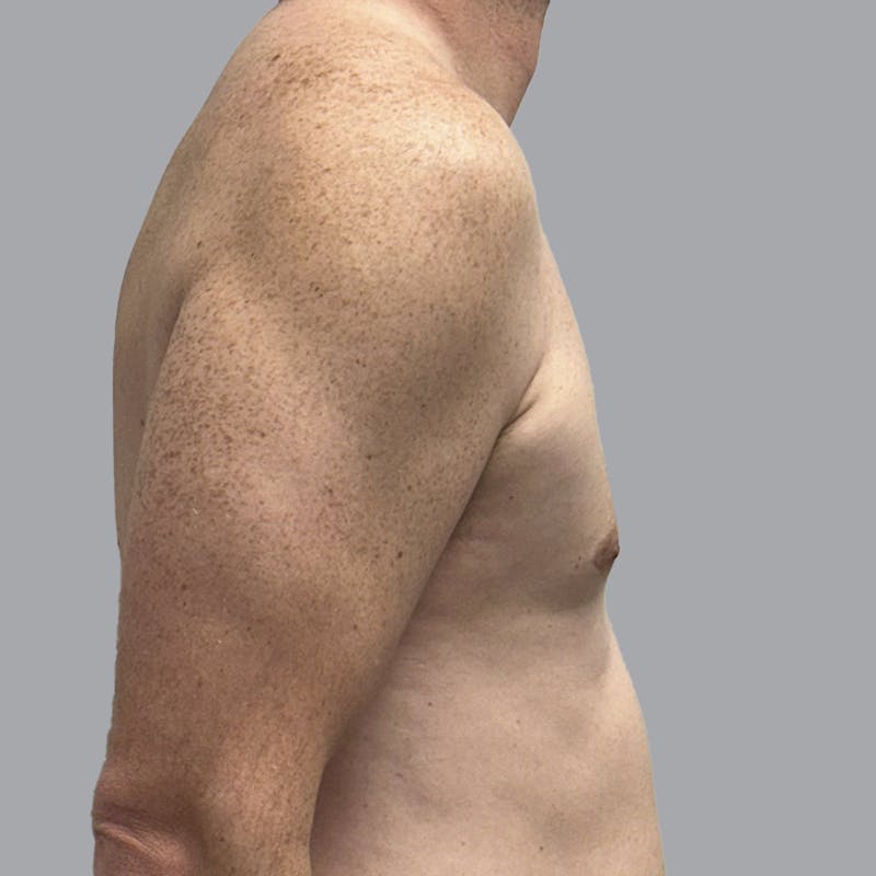 Gynecomastia Before & After Gallery - Patient 414162 - Image 4