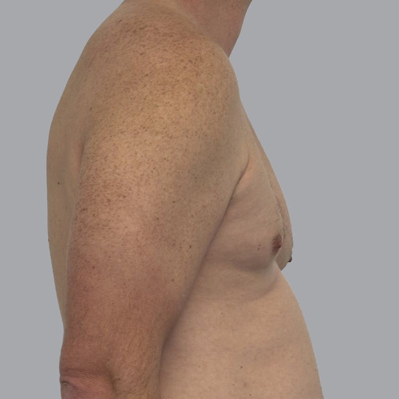 Gynecomastia Before & After Gallery - Patient 414162 - Image 3