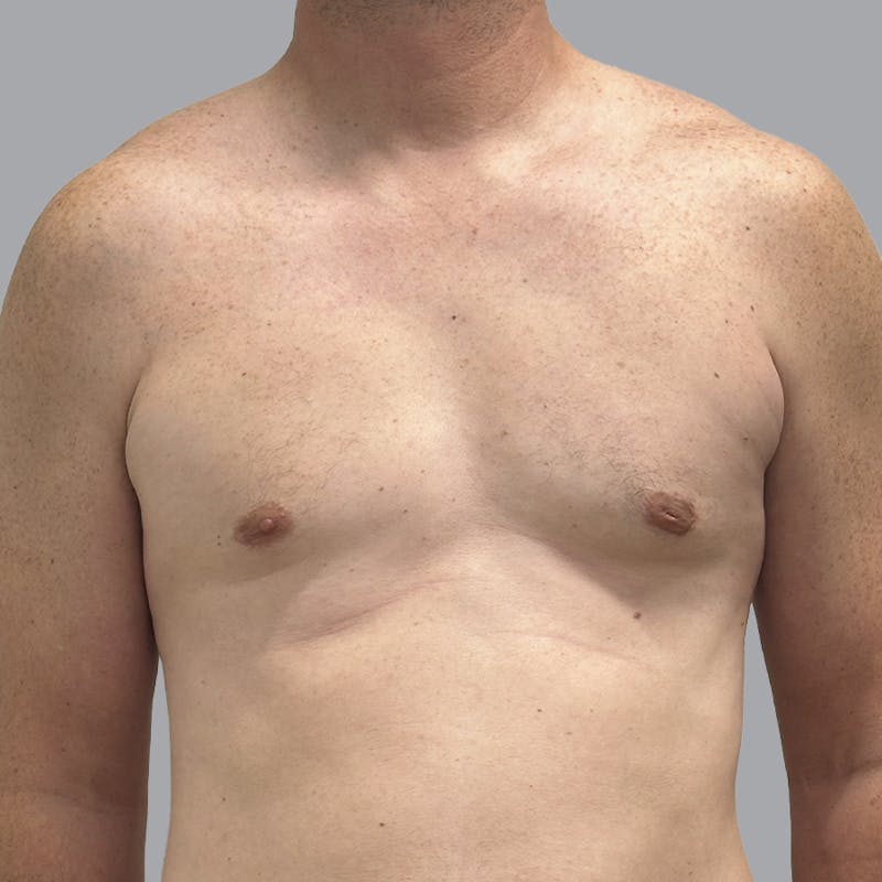Gynecomastia Before & After Gallery - Patient 414162 - Image 2