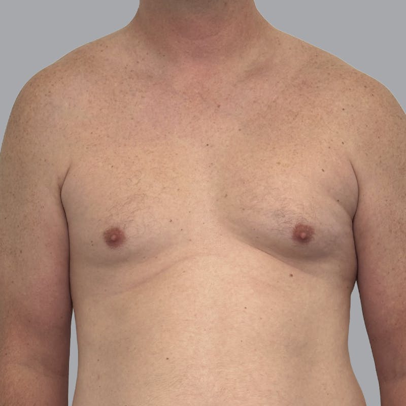 Gynecomastia Before & After Gallery - Patient 414162 - Image 1