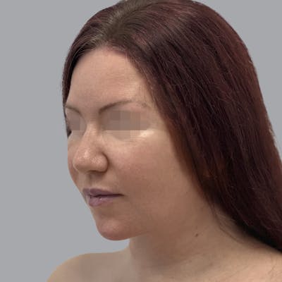 Facelift and Neck Lift Before & After Gallery - Patient 404832 - Image 4