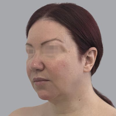 Facelift and Neck Lift Before & After Gallery - Patient 404832 - Image 3