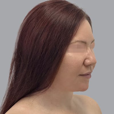 Facelift and Neck Lift Before & After Gallery - Patient 404832 - Image 6