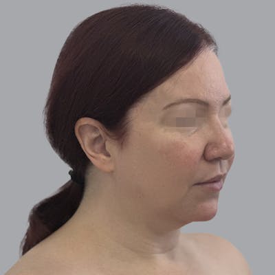 Facelift and Neck Lift Before & After Gallery - Patient 404832 - Image 5