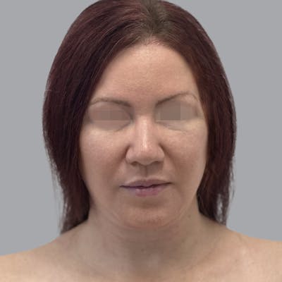 Facelift and Neck Lift Before & After Gallery - Patient 404832 - Image 2
