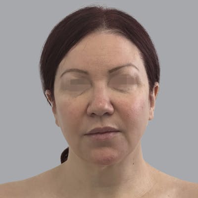 Facelift and Neck Lift Before & After Gallery - Patient 404832 - Image 1