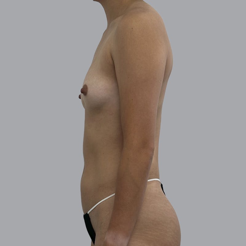 Breast Augmentation with Fat Transfer Before & After Gallery - Patient 256788 - Image 7