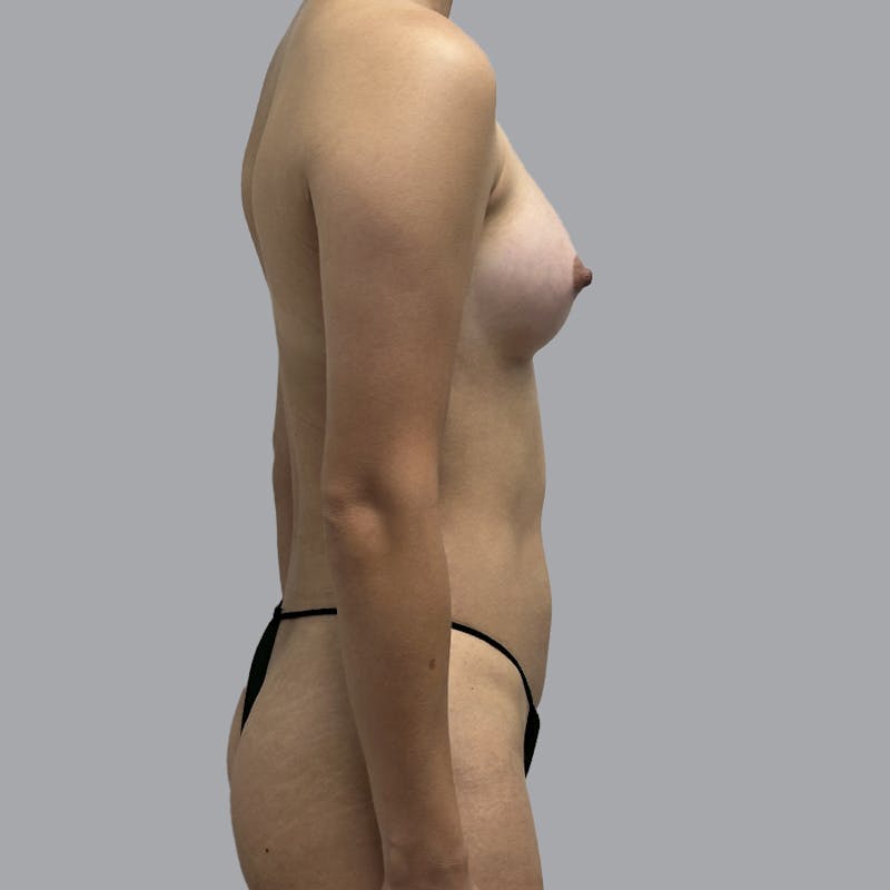 Breast Augmentation with Fat Transfer Before & After Gallery - Patient 256788 - Image 6