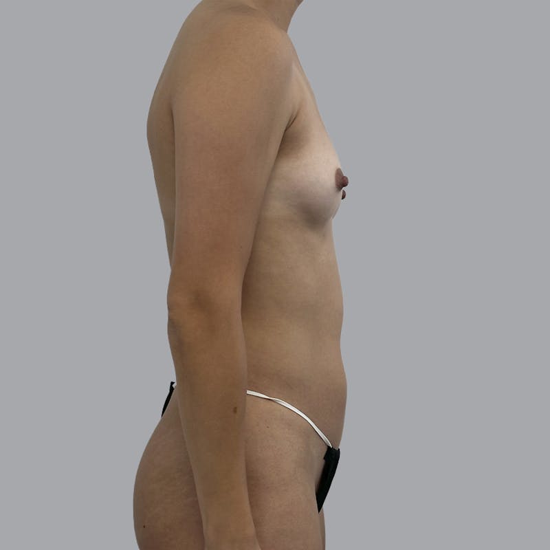 Breast Augmentation with Fat Transfer Before & After Gallery - Patient 256788 - Image 5