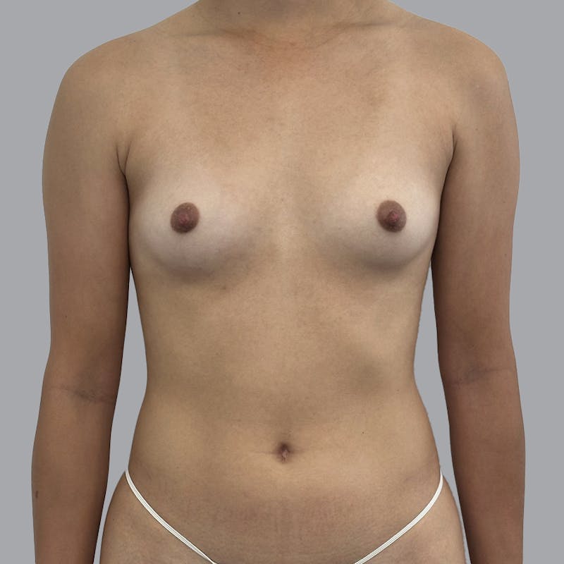 Breast Augmentation with Fat Transfer Before & After Gallery - Patient 256788 - Image 1