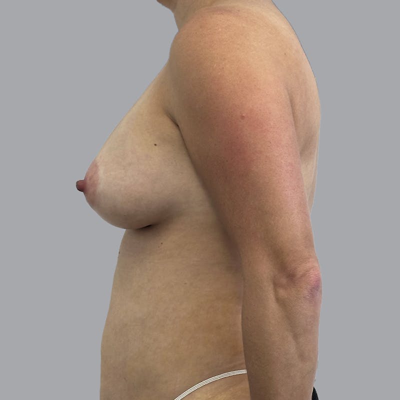 Breast Augmentation with Fat Transfer Before & After Gallery - Patient 332430 - Image 6
