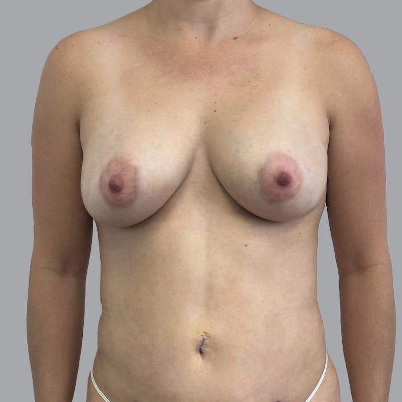 Breast Augmentation with Fat Transfer Before & After Gallery - Patient 332430 - Image 2