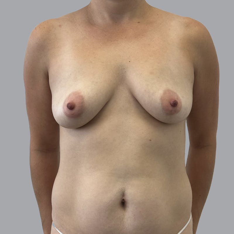 Breast Augmentation with Fat Transfer Before & After Gallery - Patient 332430 - Image 1