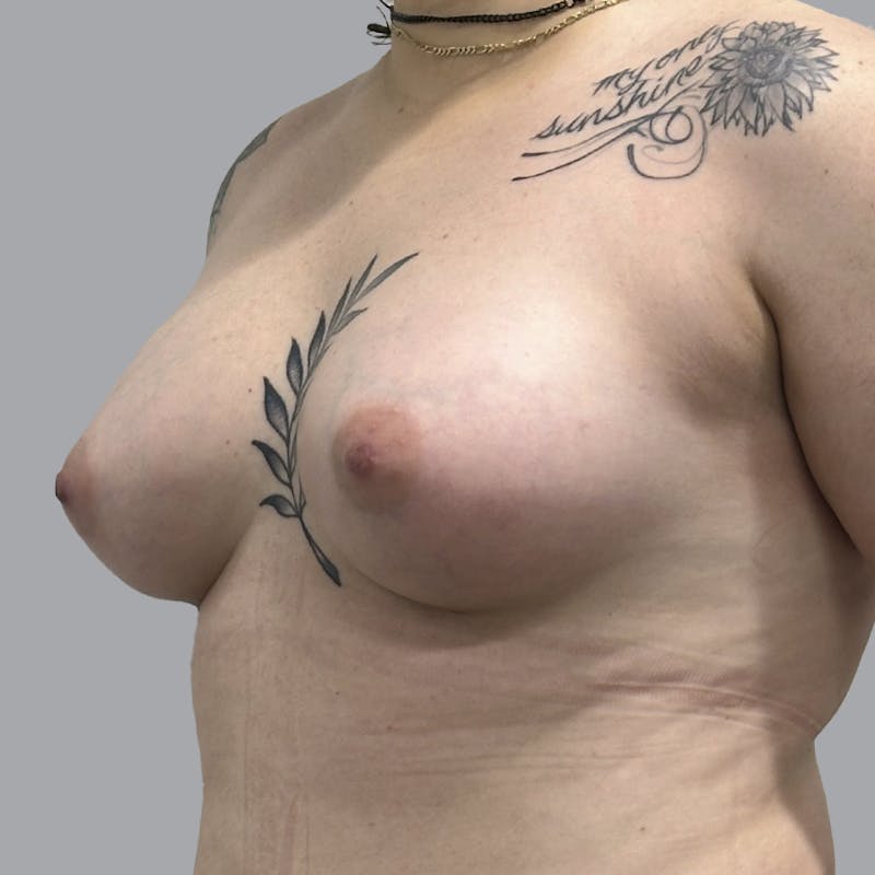 Breast Augmentation with Fat Transfer Before & After Gallery - Patient 151719 - Image 4