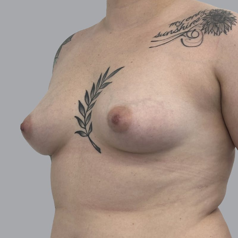 Breast Augmentation with Fat Transfer Before & After Gallery - Patient 151719 - Image 3