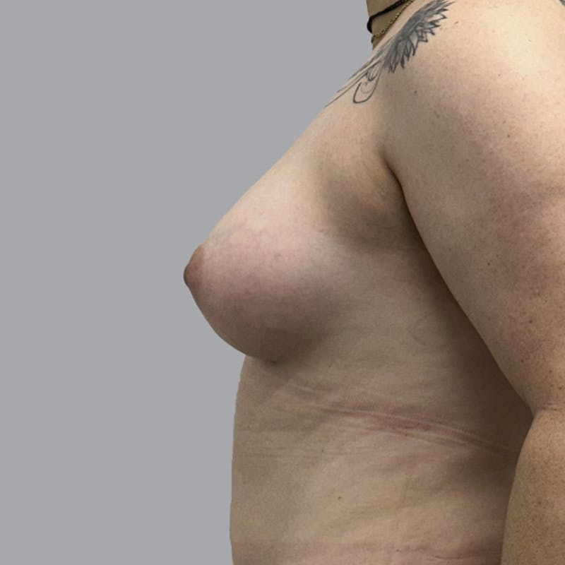 Breast Augmentation with Fat Transfer Before & After Gallery - Patient 151719 - Image 6
