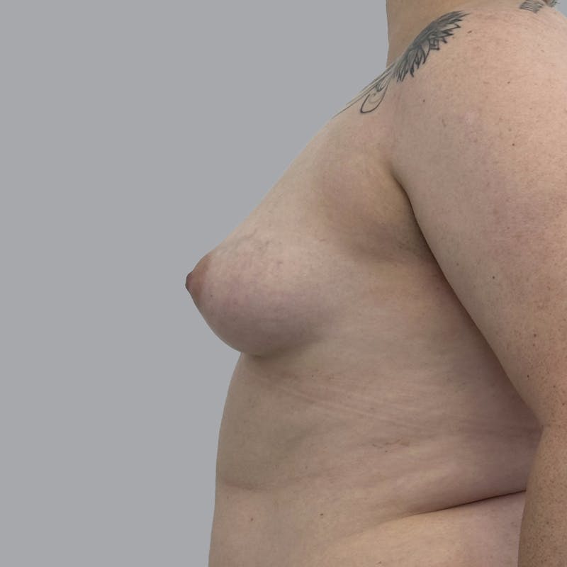 Breast Augmentation with Fat Transfer Before & After Gallery - Patient 151719 - Image 5